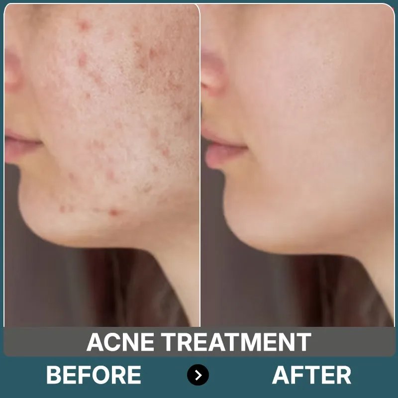 Acne Treatment Before After