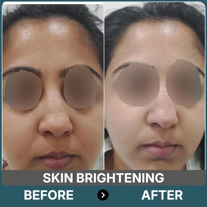 Pigmentation Treatment Before After