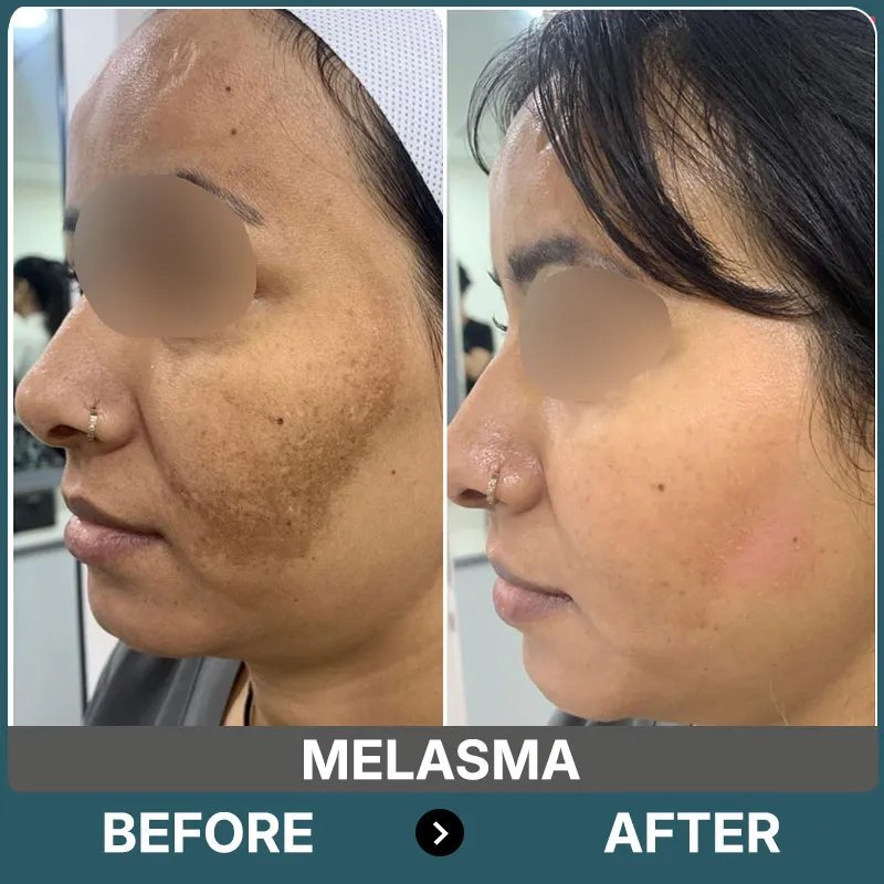 Acne Scar Treatment Before After