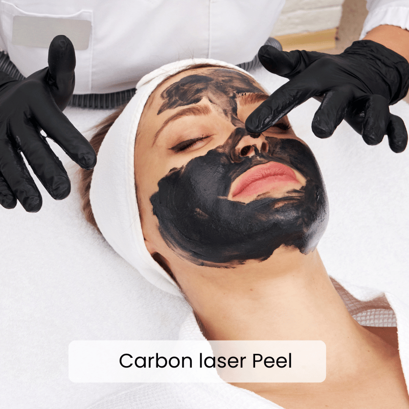 Carbon Laser Peels Treatment